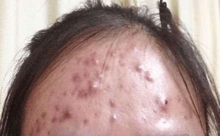 痘痘皮肤护理方法