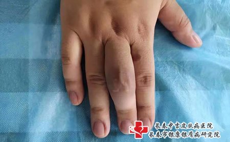 银屑病关节炎手指或脚趾肿胀