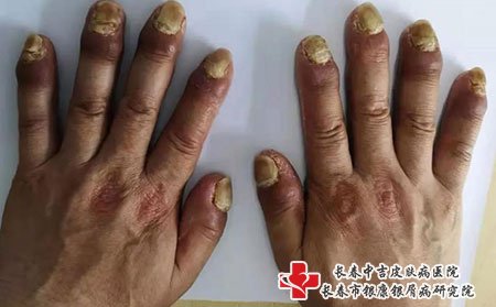 银屑病关节炎指/趾甲出现凹陷点或甲分离