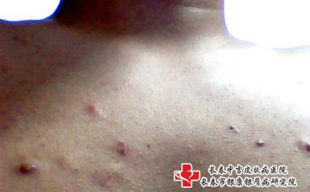 长春皮肤病医院排名：什么因素能引起粉刺?