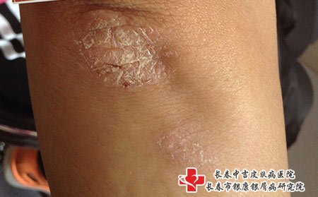长春皮肤病医院排名：为什么会出现湿疹呢?
