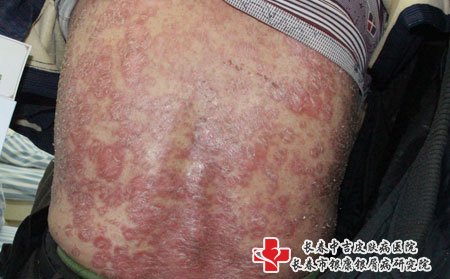 长春皮肤病医院排名:银屑病初期有哪些症状表现呢