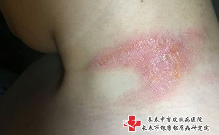 长春皮肤病医院排名：常见的化妆品导致的皮肤病有哪些