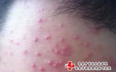 长春皮肤病医院排名皮肤科：青春痘的类型有哪些?