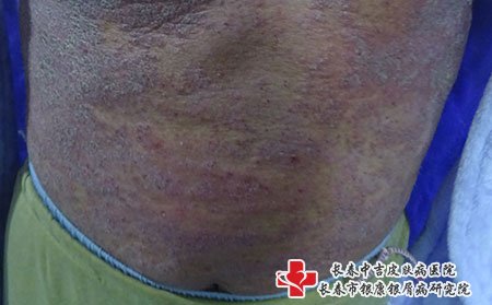 长春皮肤病医院排名,预防牛皮癣