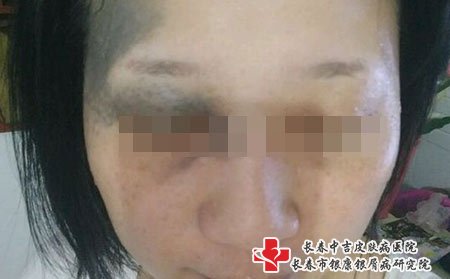 长春皮肤病医院排名：太田痣的危害都有哪些?