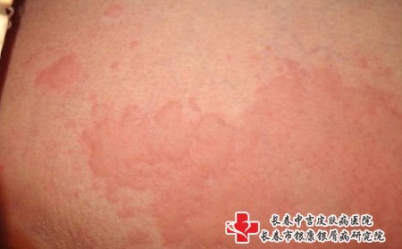 长春皮肤病医院排名,丘疹性荨麻疹,夏季预防荨麻疹