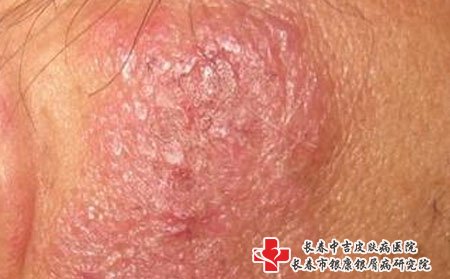 治疗湿疹的药物,哪些药物可以治湿疹