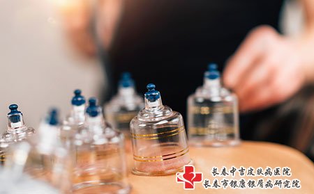 长春银屑病专科医院 拔火罐治疗牛皮癣