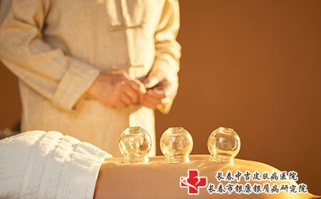 长春牛皮癣专科医院 拔火罐治疗牛皮癣