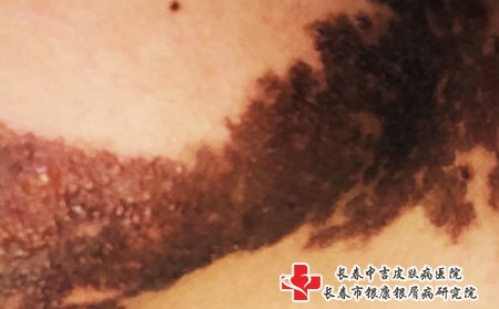 长春好的去胎记医院：胎记去除的较佳年龄