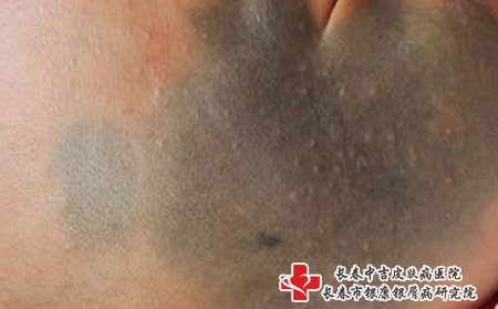 长春好的胎记医院：什么是青胎记?有哪些危害?