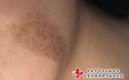 褐色胎记,长春好的胎记医院,褐色胎记有哪些症状