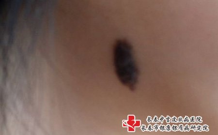 黑色胎记,长春祛胎记哪家医院好