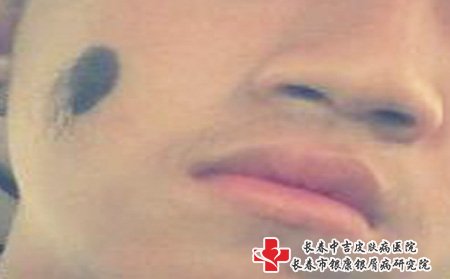 长春正规胎记医院：为什么要祛除青胎记?