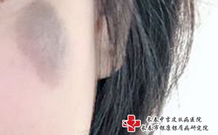褐色胎记,宝宝褐色胎记,长春去胎记比较专业的医院