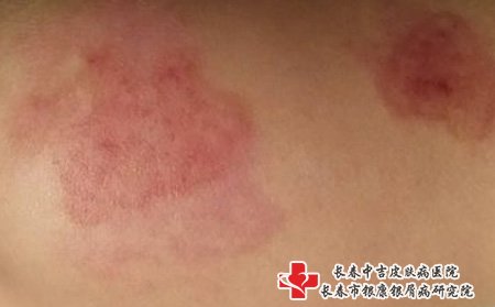 红胎记,长春治胎记哪个医院好