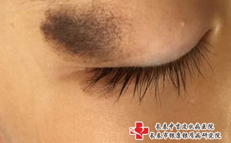 褐色胎记,长春哪个医院去胎记好