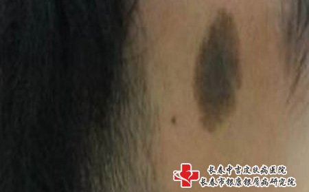 长春治胎记哪个医院好：胎记需要进行治疗吗?