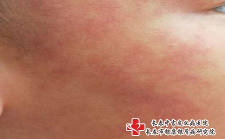长春胎记医院哪里好：胎记影响孩子健康吗
