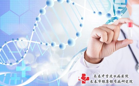 患上牛皮癣怎样治,得了牛皮癣要怎样治