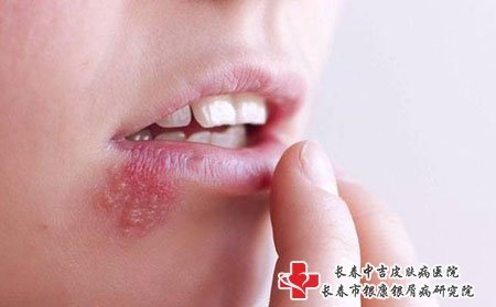 长春好皮肤病医院：带状疱疹症状是什么样的