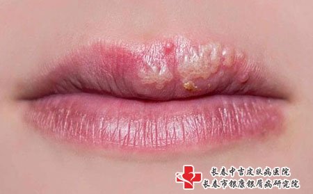 长春皮肤病医院好：生活中如何有效预防带状疱疹