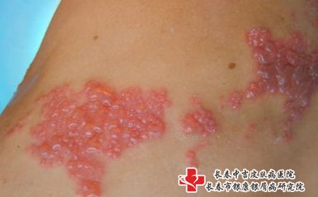 长春看皮肤病医院：带状疱疹有什么并发症