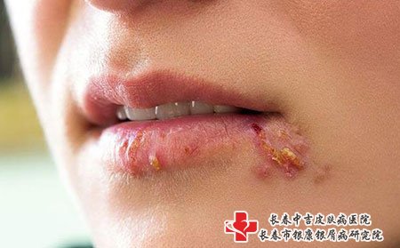 长春皮肤病医院前十名医生揭秘带状疱疹的发病原因