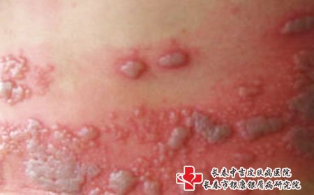长春皮肤病医院排名榜：带状疱疹的七大症状表现