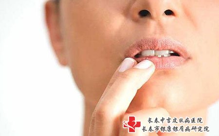 皮肤病长春医院,带状疱疹吃什么好