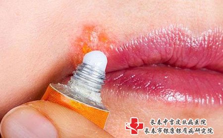 长春看皮肤病好医院:什么原因导致带状疱疹发生