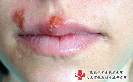 长春皮肤病专科医院：治疗带状疱疹的好方法