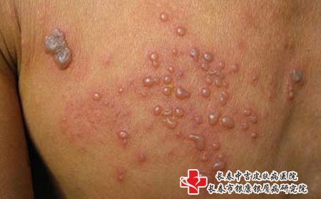 长春中吉皮肤病医院:治疗带状疱疹要有哪些要求