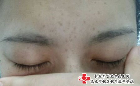 长春激光祛斑贴吧：女人长雀斑的几大原因?