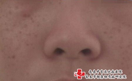 长春专业祛斑：雀斑的症状特点表现详解