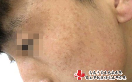 长春祛斑价格表,脸上雀斑,皮肤斑
