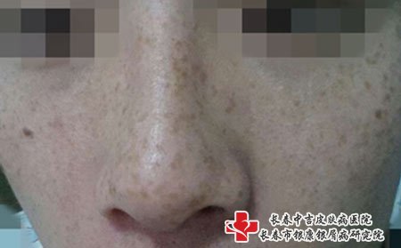 长春皮秒激光祛斑：激光祛斑就没有不良反应吗雀斑?治疗后应该怎么护理?