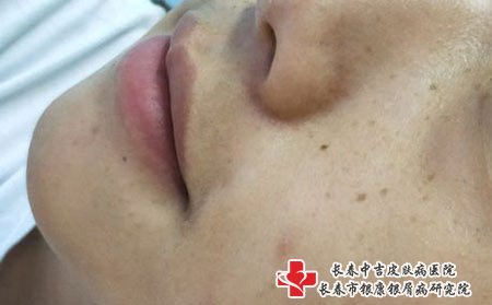 长春祛斑美容院,激光祛雀斑,长春中吉皮肤病医院