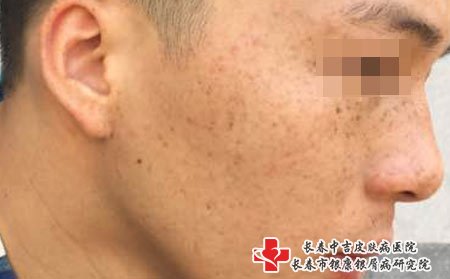 长春治疗祛斑：引起雀斑的发病原因