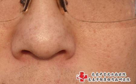 长春激光祛斑：雀斑和黄褐斑的区别