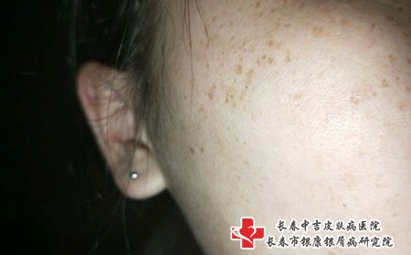 长春祛斑价格：雀斑和晒斑有哪些区别