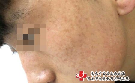 长春市祛斑：长雀斑的图片辨别生成原因如何去除