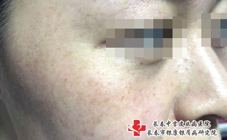 长春祛斑激光,什么是雀斑,祛除雀斑,雀斑术后护理