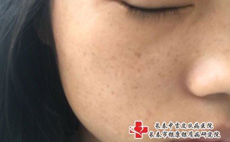 长春的祛斑:雀斑是什么,雀斑的发病原因