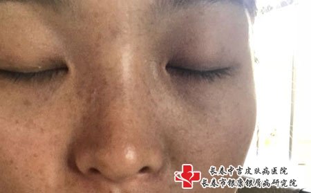 长春美容医院祛斑：激光祛除雀斑后皮肤变黑的原因