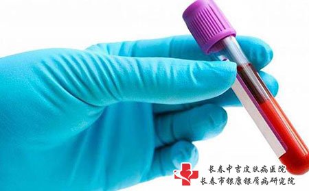 激光治疗雀斑