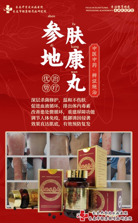参地肤康丸治疗牛皮癣,治牛皮癣用参地肤康丸