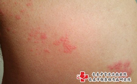 女性皮炎症状,女性长皮炎什么样