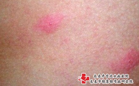 夏季皮肤瘙痒,夏天皮肤很痒